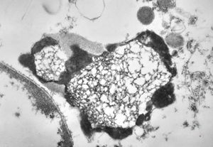 M,46y. | prostate - residual lysosome M,46y. | prostate - residual lysosome